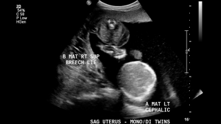 twin-twin-transfusion-ultrasound-canonical.jpg
